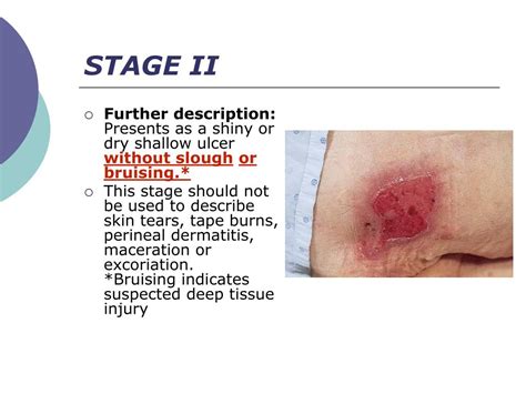 pressure ulcer staging powerpoint