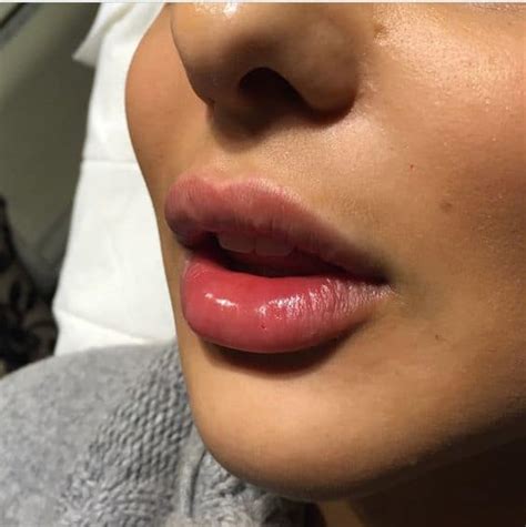 Lip Fillers And Why Is Everyone Getting Them The Fashion