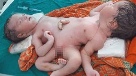 Sex lives of conjoined twins