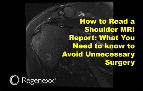 How To Read A Normal Vs Abnormal Shoulder Mri Regenexx