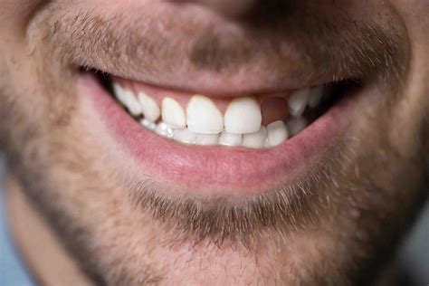 dental implants   teeth dental news network