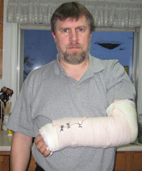 fractured arm fracture treatment