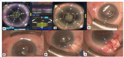 Femtosecond Laser Assisted Cataract Surgery In Patient 2