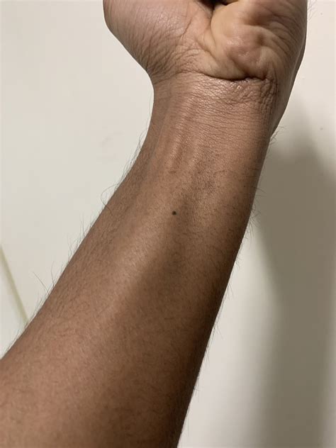 unusually large bumps   wrists   hands    pictures askdocs