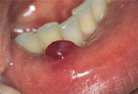 short note  mucocele oral surgey dentistry  medicine