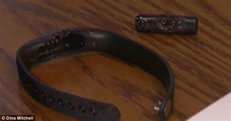 Woman Suffered Second Degree Burn When Her Fitbit Exploded
