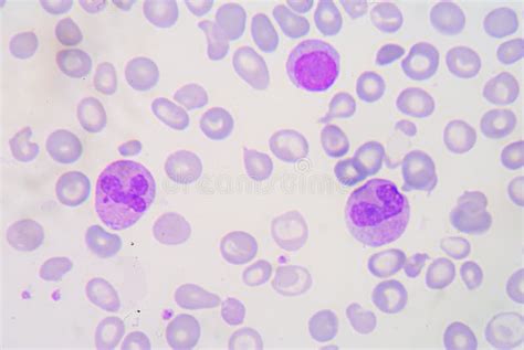 blood smear beta thalassemias  thalassemias   group  stock