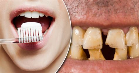 british people have some of the worst teeth on earth tv doctor claims