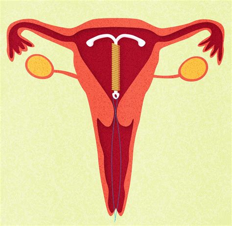 Sex With An Iud What You Need To Know