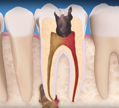 endodontics dms dentistry