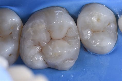 complex layering  rebuild  broken  molar