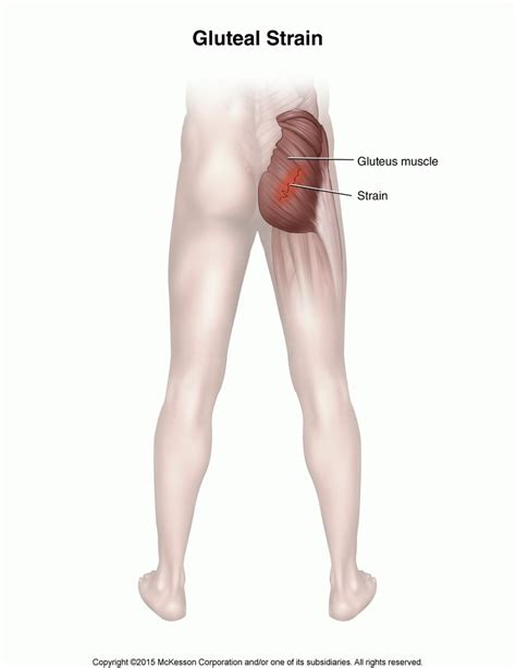 Gluteal Strain Tufts Medical Center Community Care