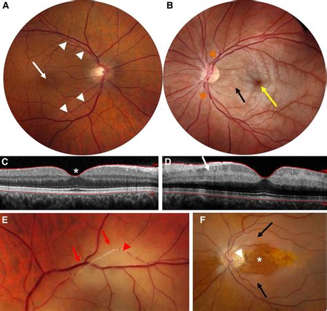 Management Of Central Retinal Artery Occlusion A Scientific Statement