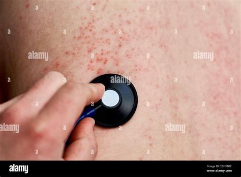 allergischer hautausschlag frau mit dermatologie problem auf der haut