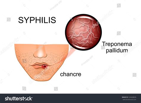 illustration syphilis symptoms causative agent stock vector 524428639 shutterstock