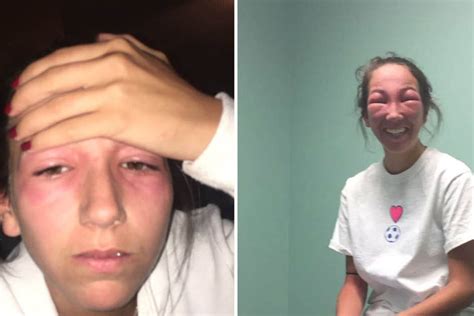 This Woman Got Poison Ivy In Her Eyes And The Photos Are Going Viral