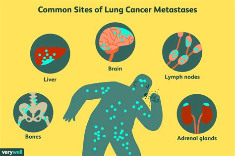 common sites  lung cancer metastases