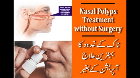 Nasal Polyps How Nasal Polyps Treatment Miracle Helps People Treat My