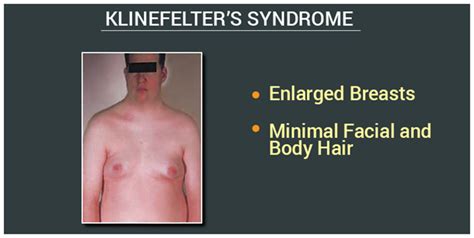 Klinefelter Syndrome Causes Symptoms And Treatment