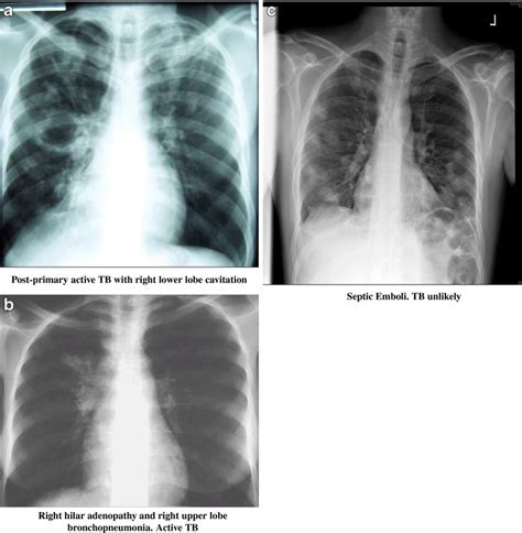 examples  chest  rays   tuberculosis cxr image