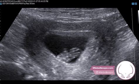 bellies ultrasound pregnancy spa dallas