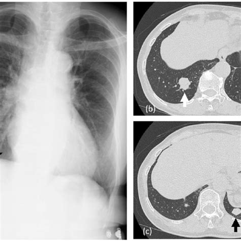 A The Chest X Ray Showed A Mass Shadow In The Right Lower Lung