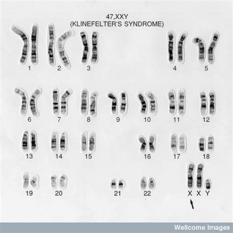 File 47 Xxy Klinefelters Syndrome  Embryology