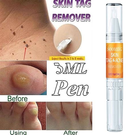 3ml skin face tag remover genital wart treatment removal mole