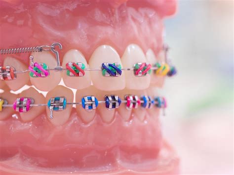 kinds  braces stanley dentistry