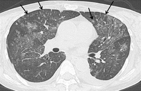 Figure 3 From High Resolution Ct Findings Of Pulmonary Infections In