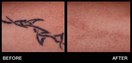 details  laser tattoo removal miami ineteachers