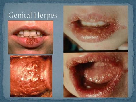 Sexually transmited disease pictures