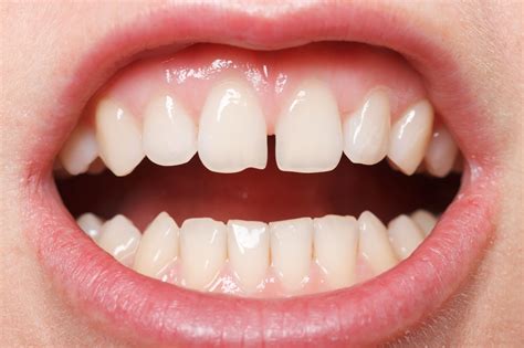 fix  smile treatments  chipped teeth