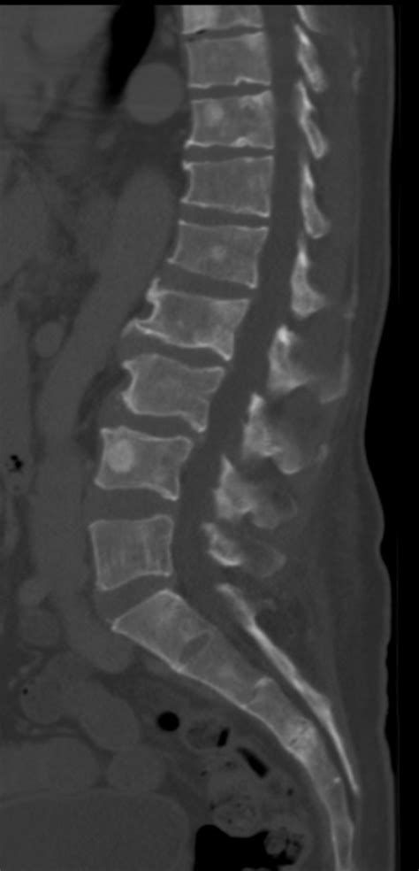 filect  osteoblastic lesions  multiple myelomajpg wikipedia