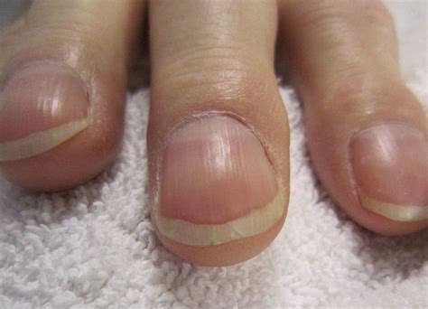 Nail Clubbing Definition Causes And Diagnosis