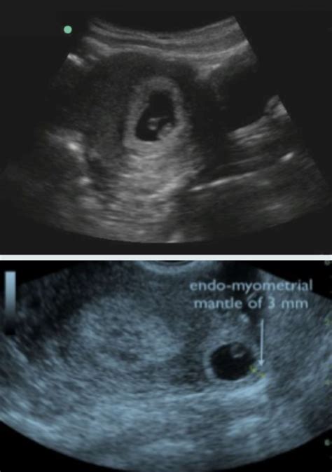 Brown Sound Ultrasound Diagnosis Of Ectopic Pregnancy