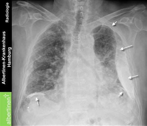 roe thorax asbestose plaques pa doccheck