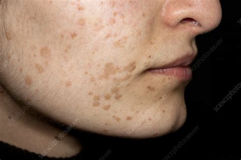flat warts   face stock image  science photo library