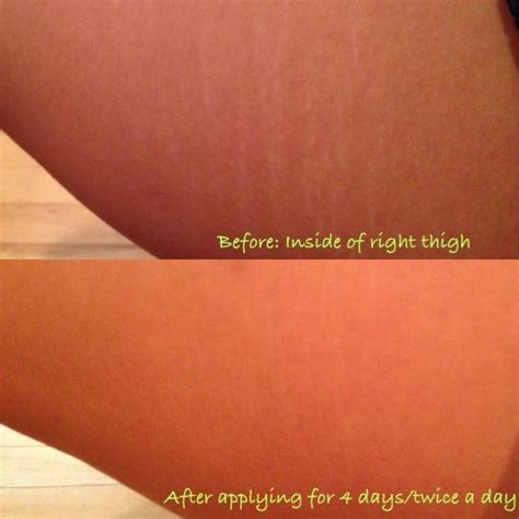 Most Stretchmark Creams Out There Only Treat Dark Red Stretch Marks Or