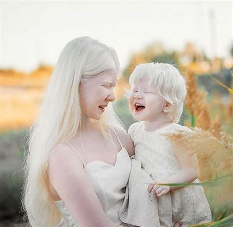 beautiful albino sisters  kazakhstan overcome  odds