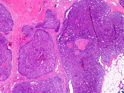 pathology outlines intraductal papilloma