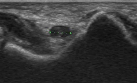 Musculoskeletal Joints And Tendons 6 2 Elbow Case 6 2