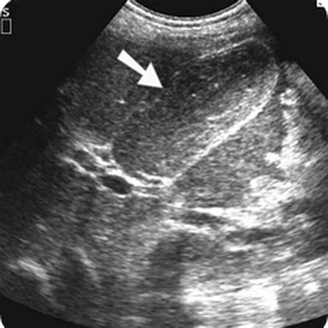 ultrasound images biliary crystals radiology imaging
