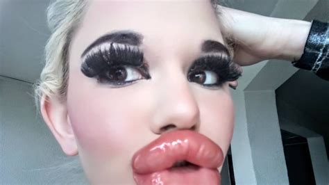 real life barbie shows off giant lips after 20th filler injection