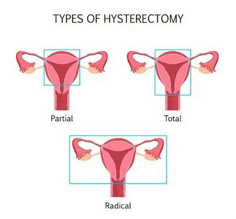 Female Hysterectomy Treatment Mathrutva A Unit Of Max Fertility