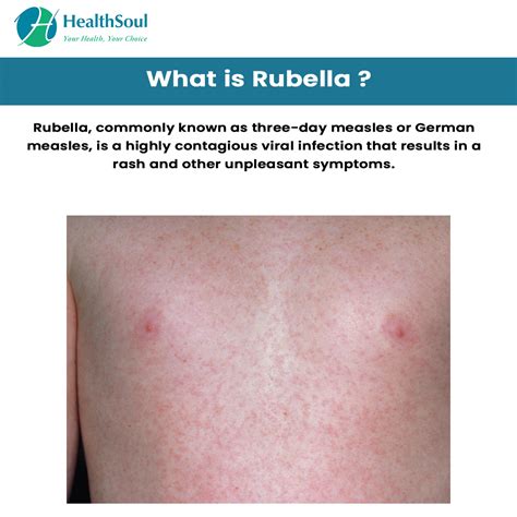 rubella symptoms  treatment infectious disease healthsoul