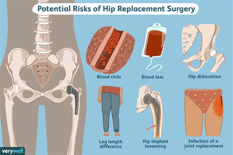 Hip Replacement Surgery Recovery What To Expect And More