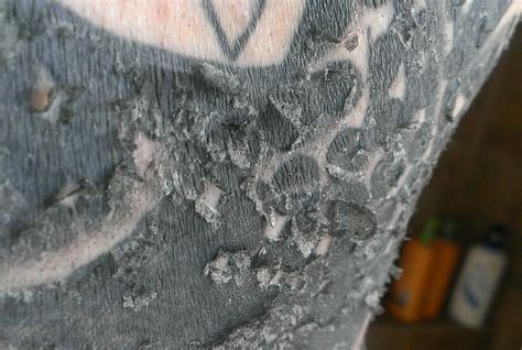 tattoo peeling  flaking