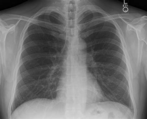 file chest xray pa 3 8 2010 png wikimedia commons
