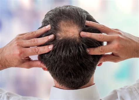 bald spot concealers  color  scalp    bald spot  noticeable